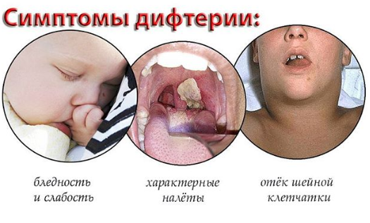 визуальные симптомы заболевания дифтерией - три примера