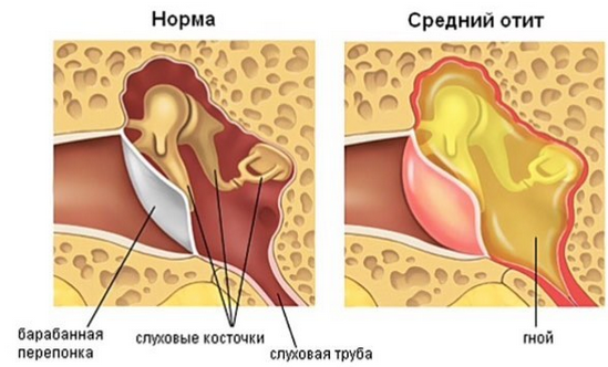 заболевание отит что происходит в ухе инфографика