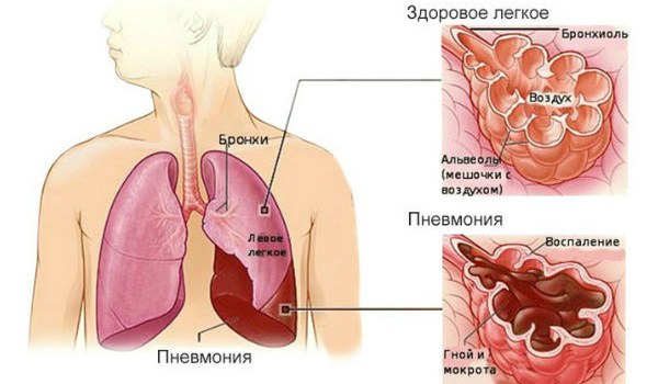 воспаление легких лечение у детей