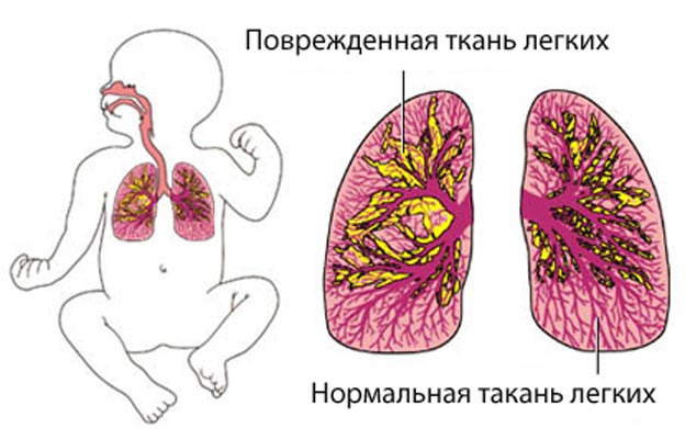 воспаление легких у детей