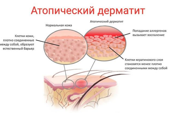 что такое атопический дерматит