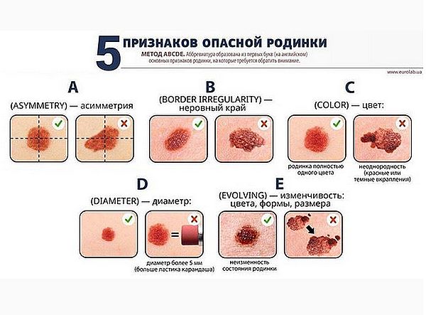 Родинки у ребенка