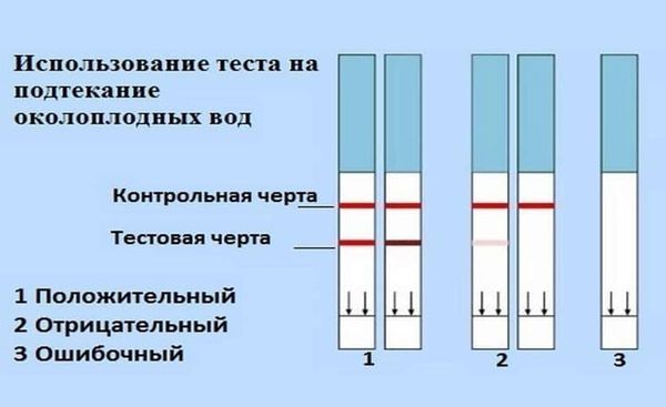 Признаки подтекания околоплодных вод и правильная диагностика