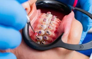 Всі види брекет-систем: якими вони бувають?