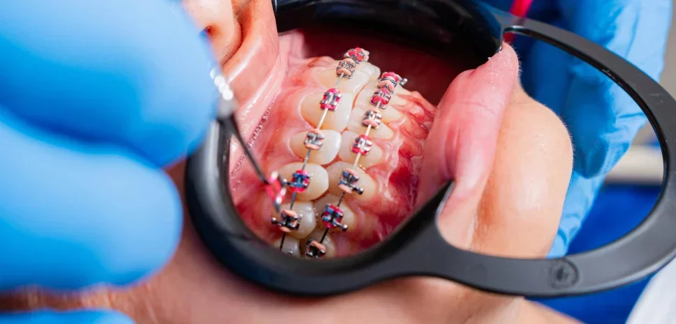 Всі види брекет-систем: якими вони бувають?