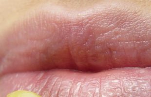 Как защитить губы от сухости зимой: действенные советы