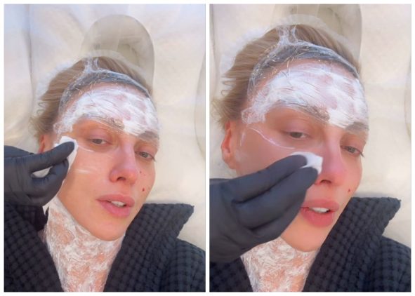 Оля Полякова процедура з омолодження 